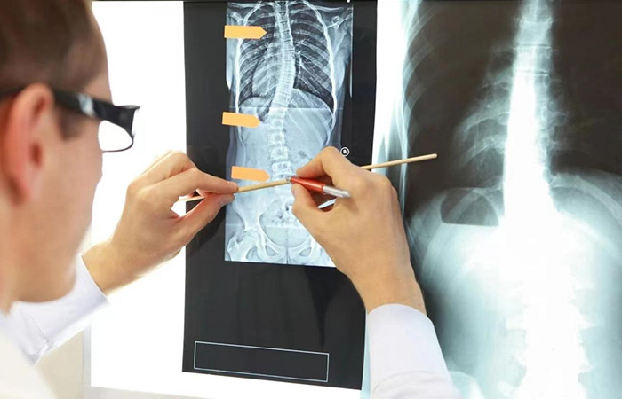 Solution for adolescent scoliosis