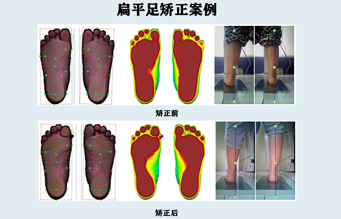 Solutions for adolescent foot correction