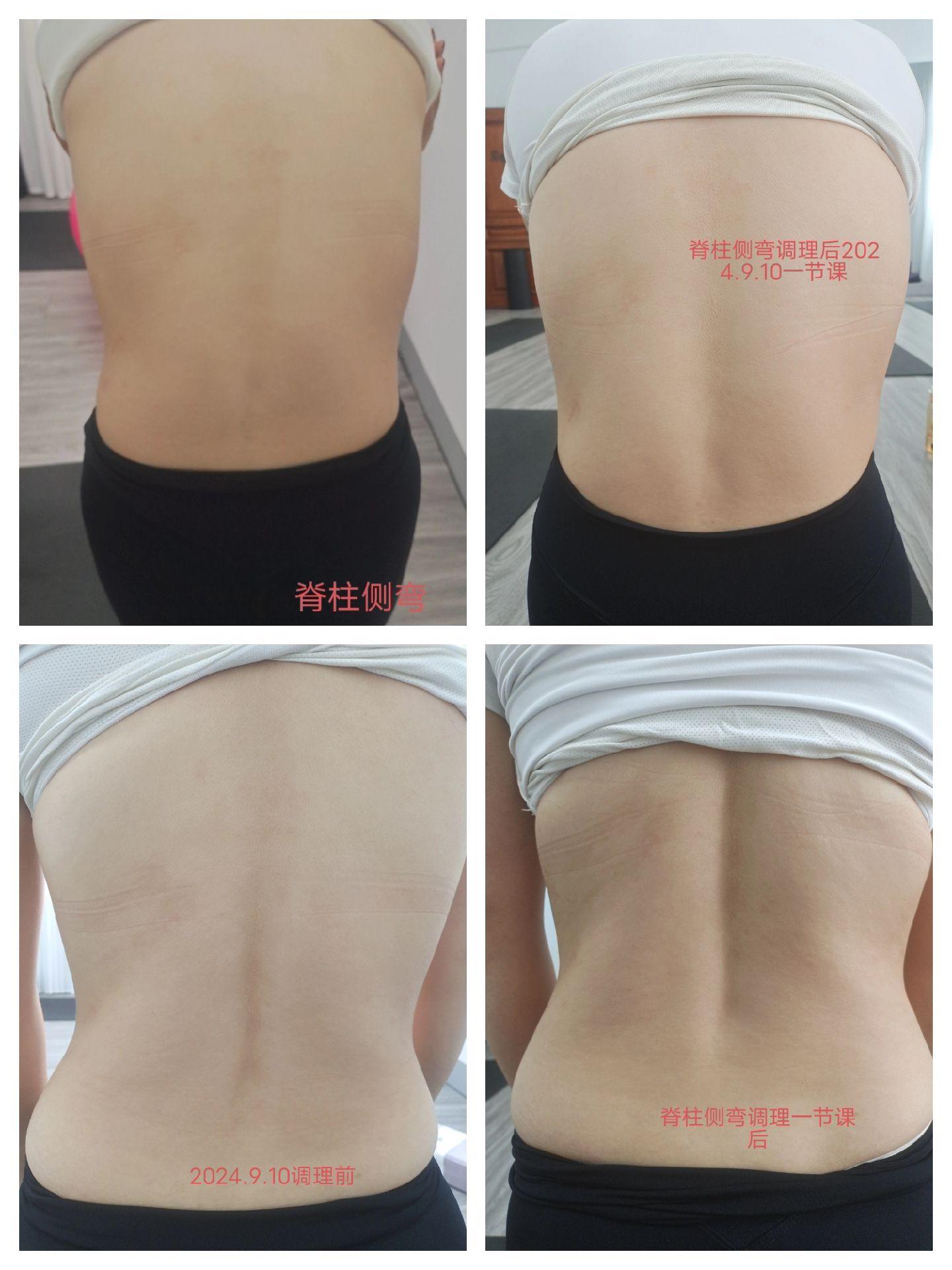 How to diagnose adolescent scoliosis
