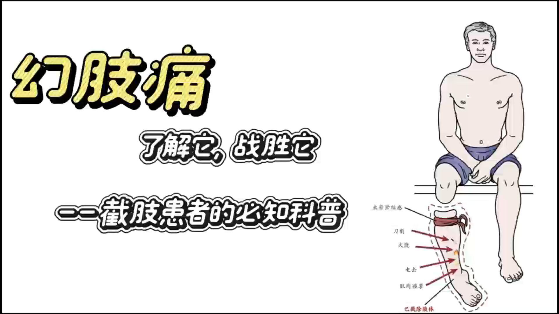 幻肢痛--截肢后你重视了吗