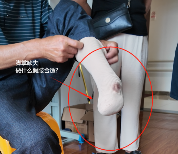 脚掌缺失 假肢如何选？