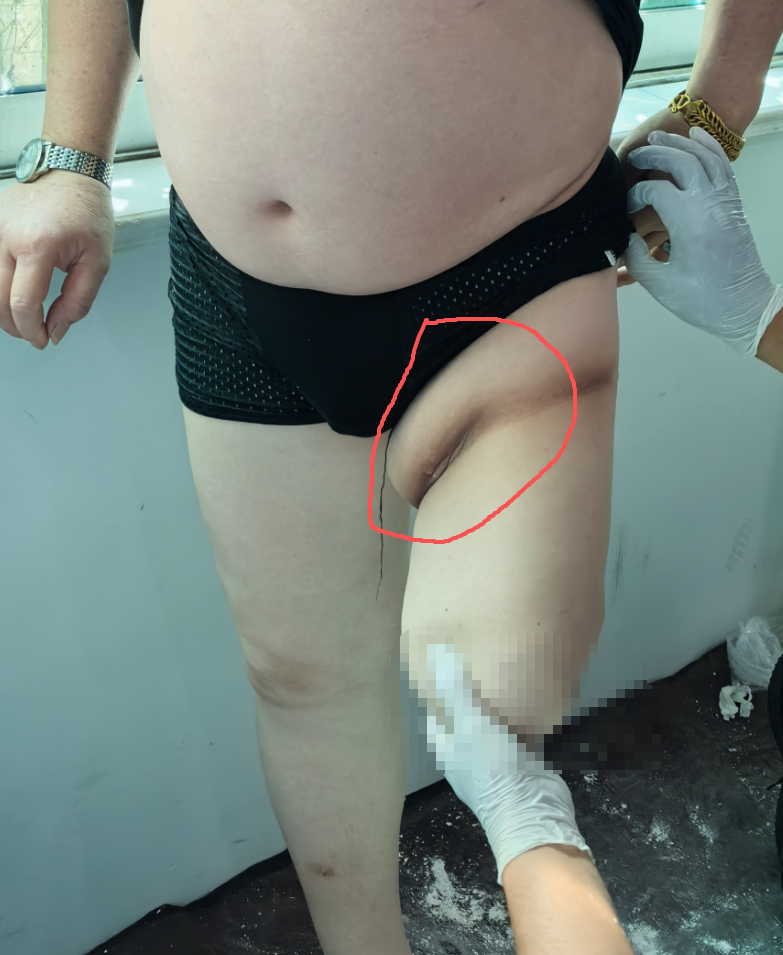 救命！假肢穿不对真的会要命…