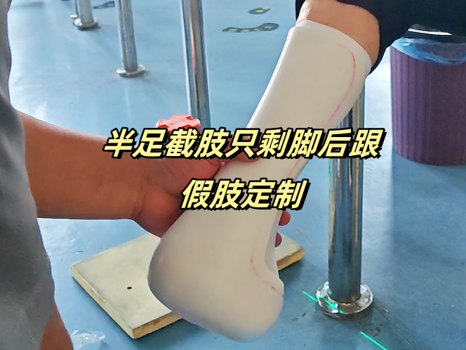 半足缺失只剩脚后跟假肢定制